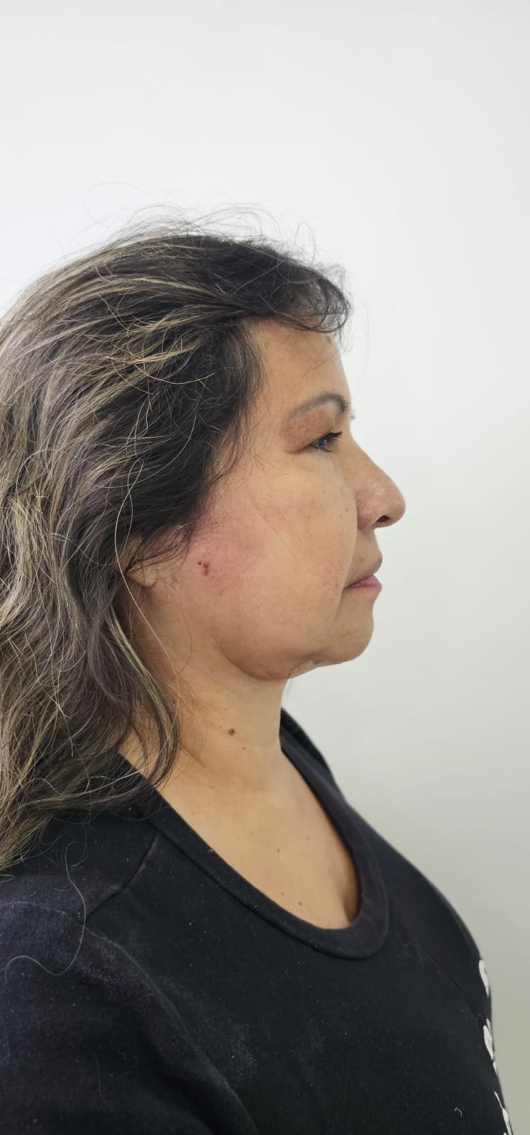 Después Lifting Facial Deep Plane Case 3